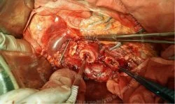 Китайский хирург завершил операцию, несмотря на то, что у него самого произошел разрыв аорты.